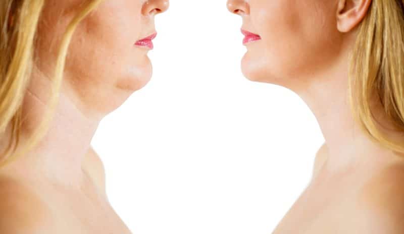 Is Double Chin Removal in Singapore Actually Worth It? Honest Results Revealed
